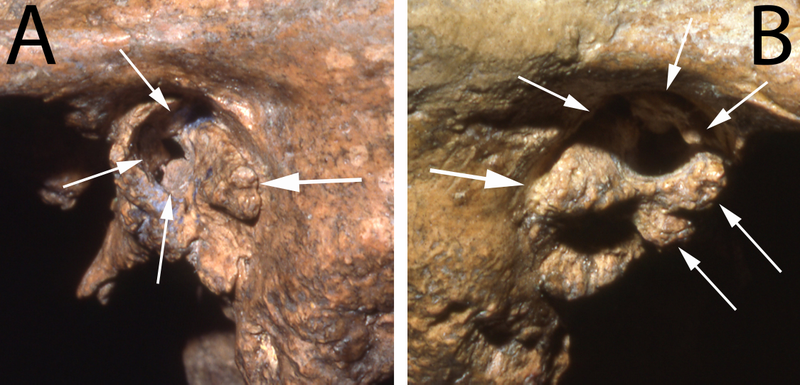 The ear canals of the Neandertal fossil Shanidar 1 show serious deformities that would likely have caused profound deafness. (Image: Erik Trinkaus)